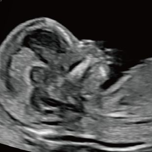 胎児ドックの様子_初期