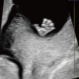 胎児ドックの様子_初期