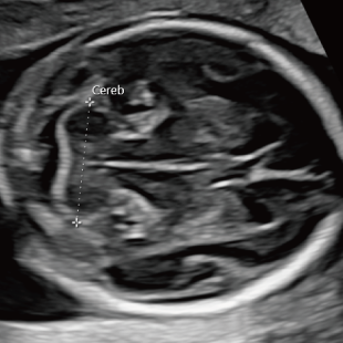 胎児ドックの様子_中期_頭