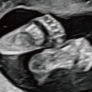 胎児ドックの様子_中期_足